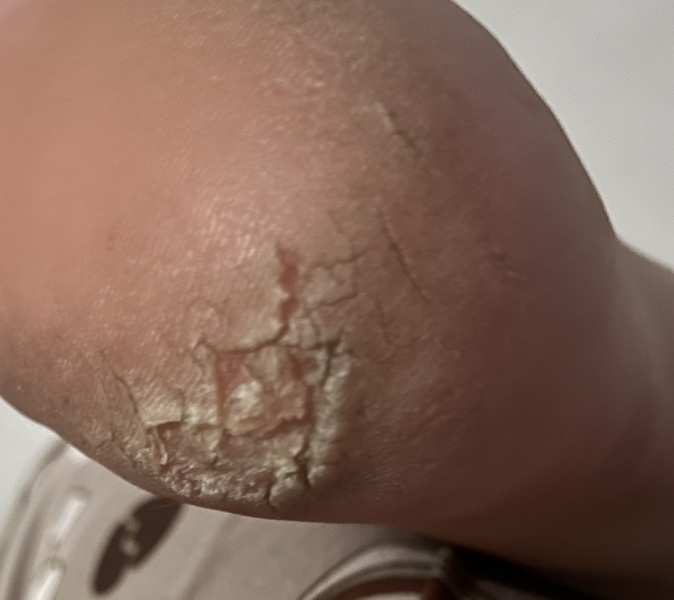 Horrifically cracked heel, help!