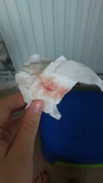 is this implantion bleeding.