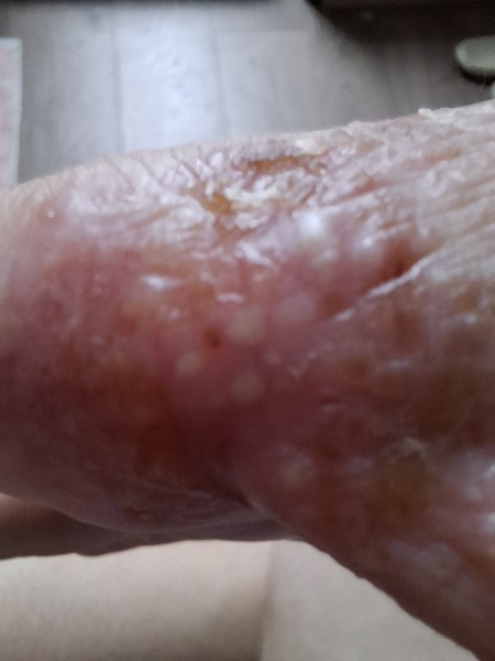 Hand infected (Warning, gross photos)