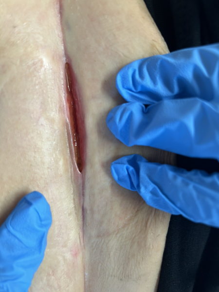 9w post c-section, still infected - please give me hope!