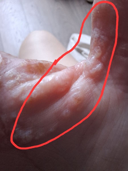 Hand infected (Warning, gross photos)