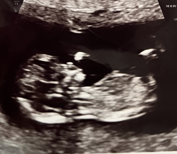 Boy or girl guess?