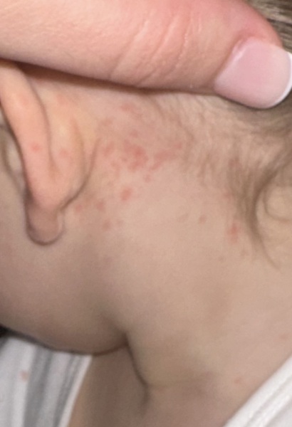 Worried my 1yo has meningitis