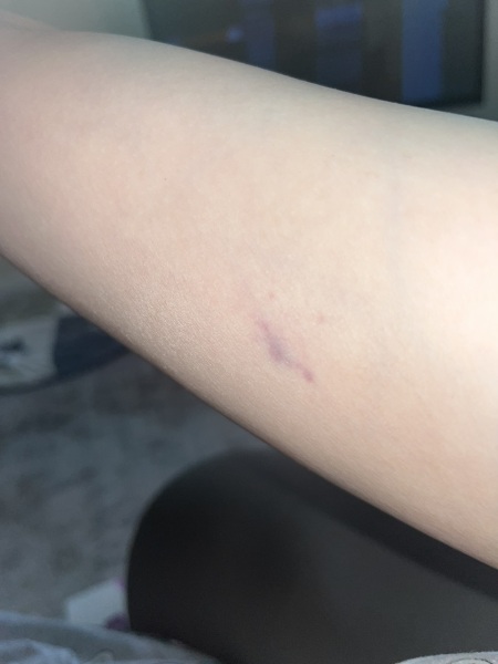 Does this look like a varicose vein?