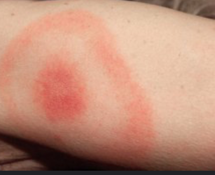 What is this bug that bit me?