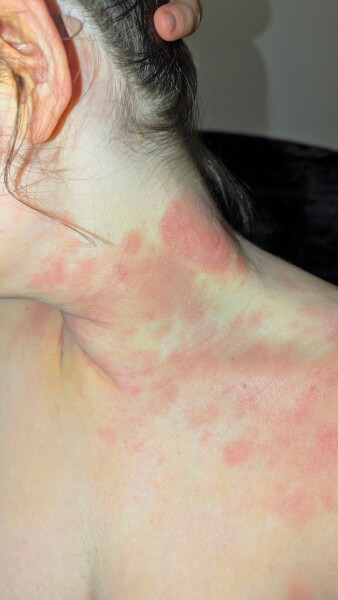 Eczema; how can I help DD