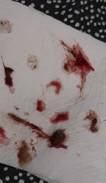 Bloody show or bleeding from membrane sweep?