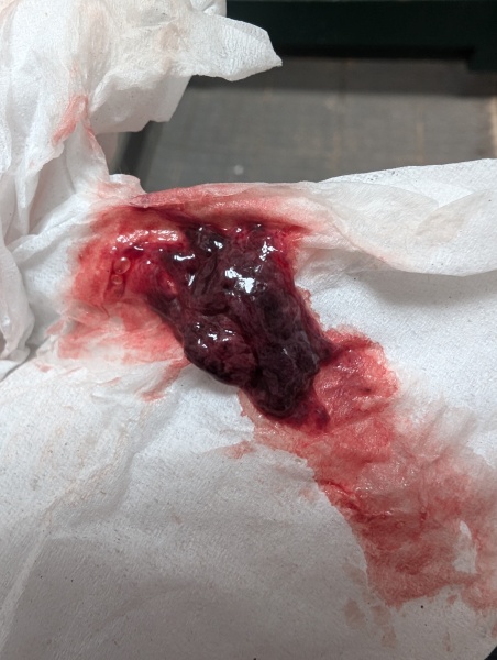 TMI - Bleeding and clots at 6 weeks pregnant.