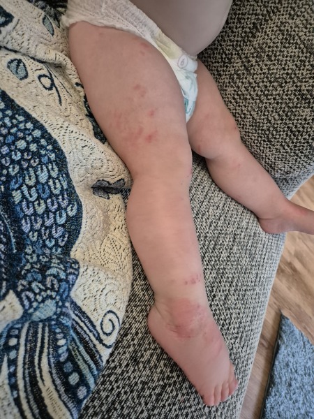 Drought secret cream on eczema!