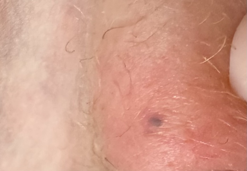 Black ‘spots’ on labia minora 