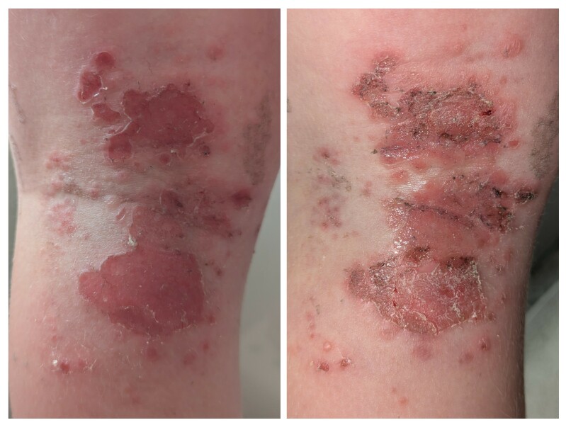 Infected bits getting worse?