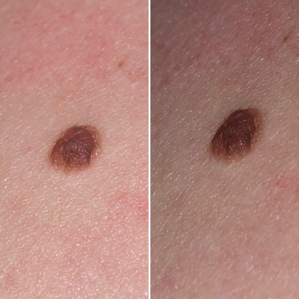 Should I be worried about this mole? Image attached.