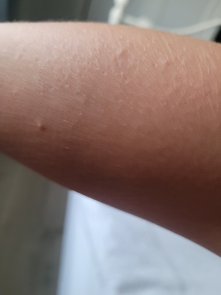 Please help identify these spots/bites