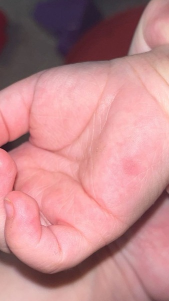 Hand foot and mouth