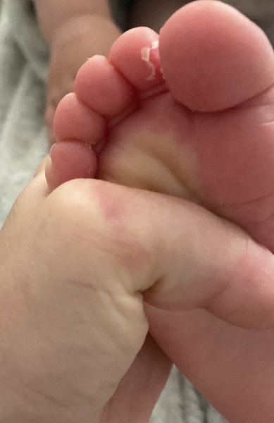 Toddler painful / peeling toes??