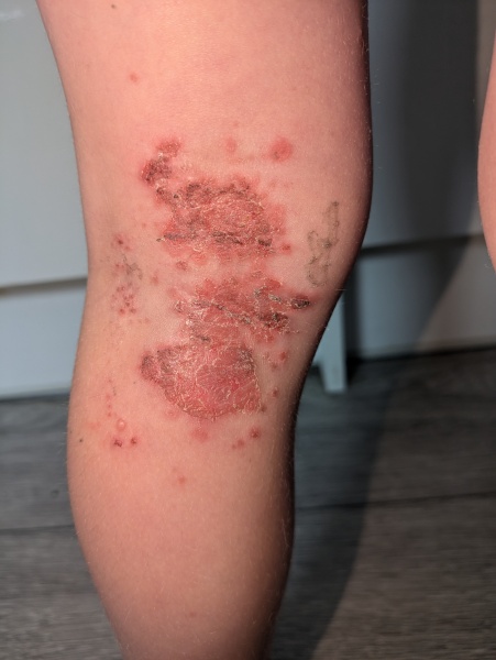 Infected bits getting worse?