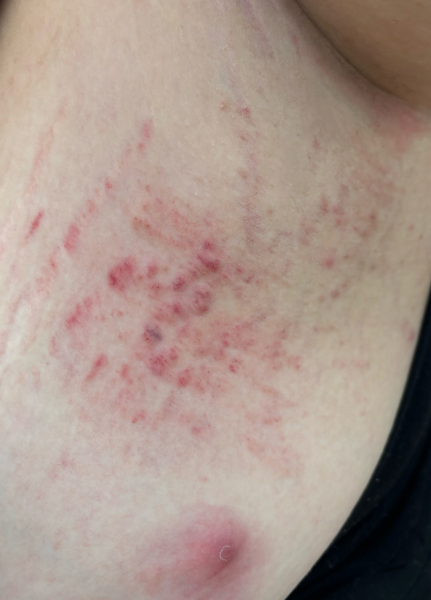 Weird itchy red rash under my armpit