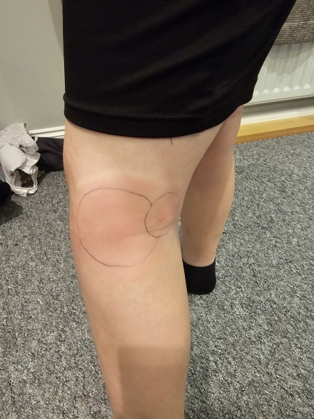 Sorry, having a panic - possible cellulitis?