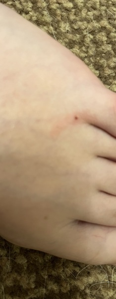 When does animal scratch need tetanus?