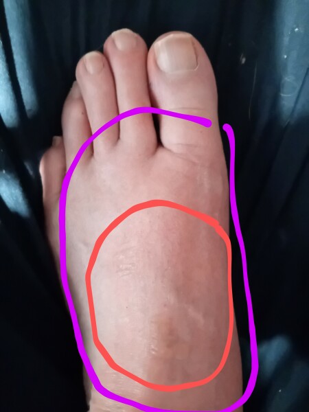 I scalded my foot last night