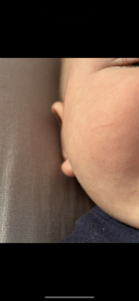 3 month old scratched his cheek - will it scar?