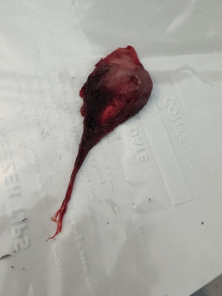 TMI - Bleeding and clots at 6 weeks pregnant.