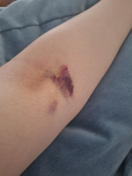 Hideous bruise from blood test
