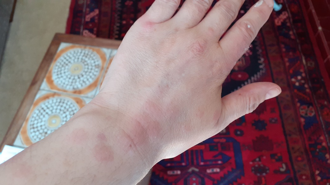 Please help keep identify these bites