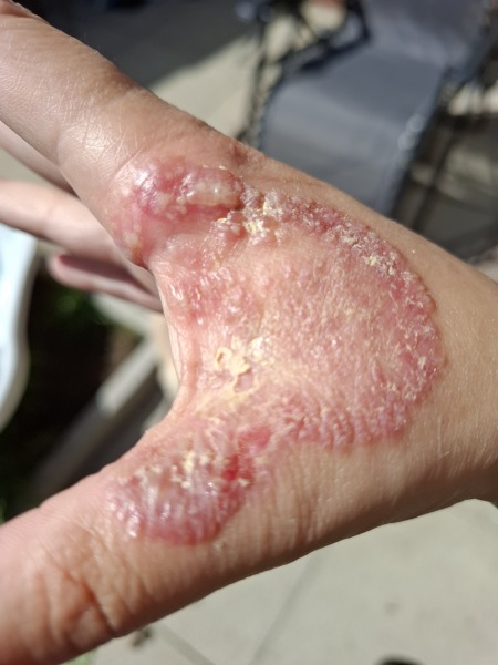 Hand infected (Warning, gross photos)