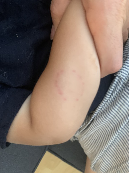 Toddler Bitten 6 Time Now at Nursery
