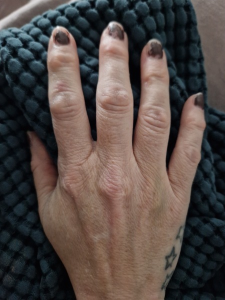 A thread for those with psoriatic arthritis?