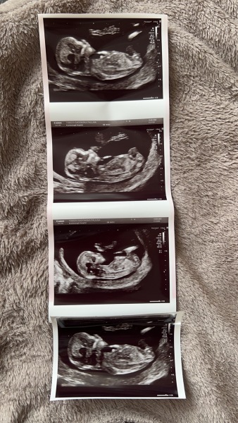 Gender guesses 13 weeks