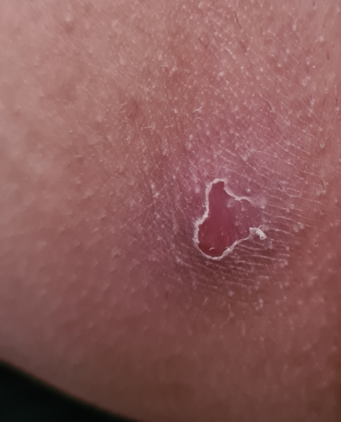 Help needed please  is this an abscess 🤔