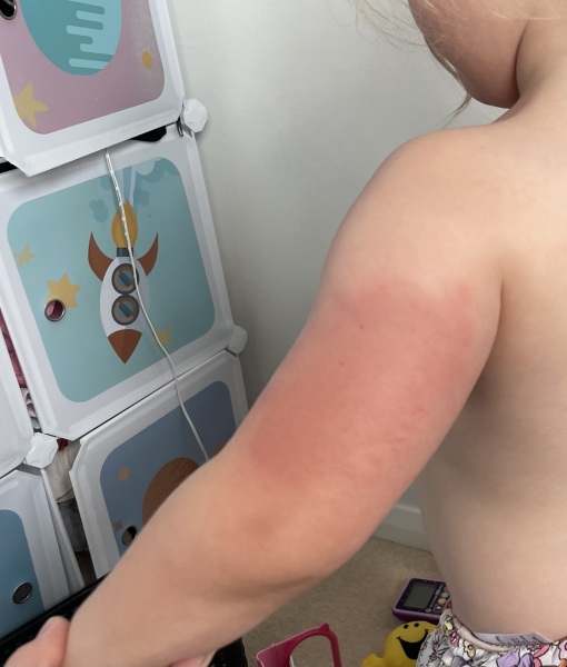 Normal after pre-school MMR?
