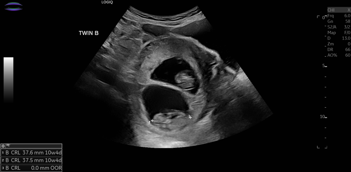 Anyone else due twins