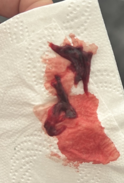 Has anyone experienced blood clots like these?