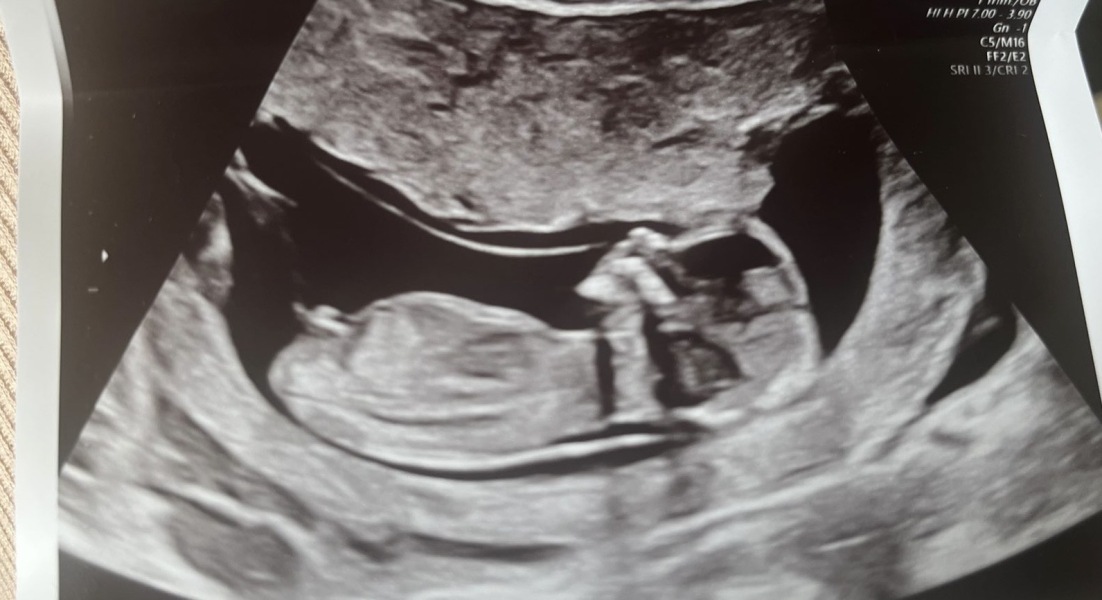 Does this look like a boy nub?
