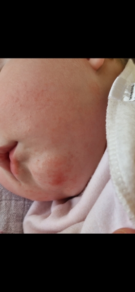 Allergy or contact reaction