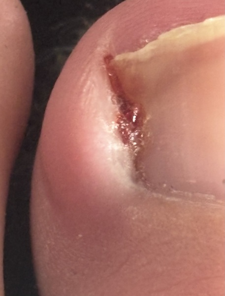 To think this is definitely ingrown?? Photo