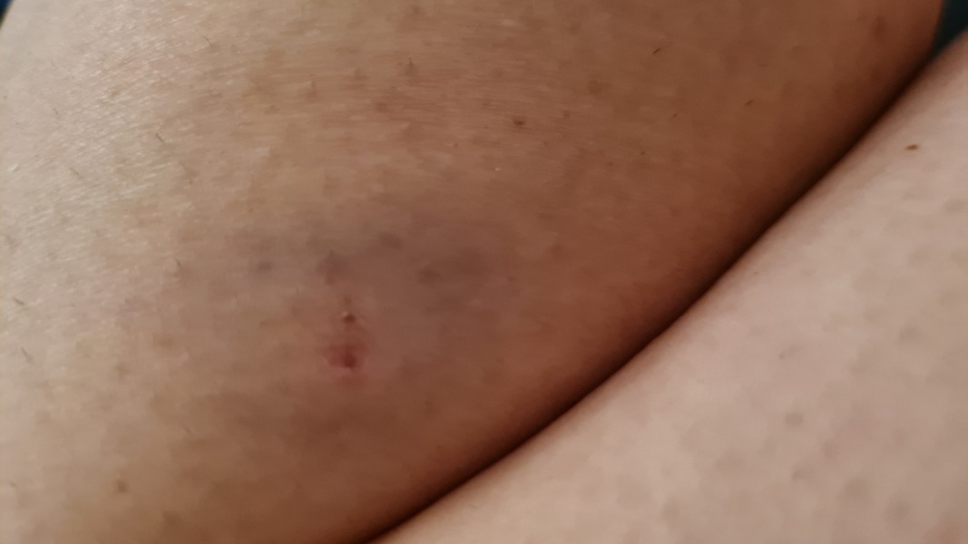 Spider or bug bite?