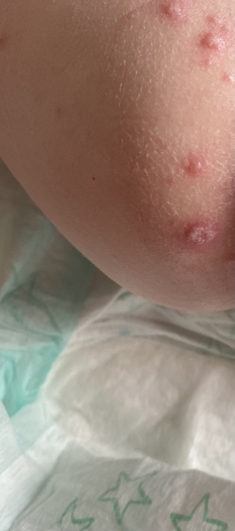Does this look like chicken pox to you? Nappy area.