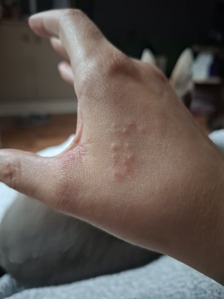 Hand infected (Warning, gross photos)