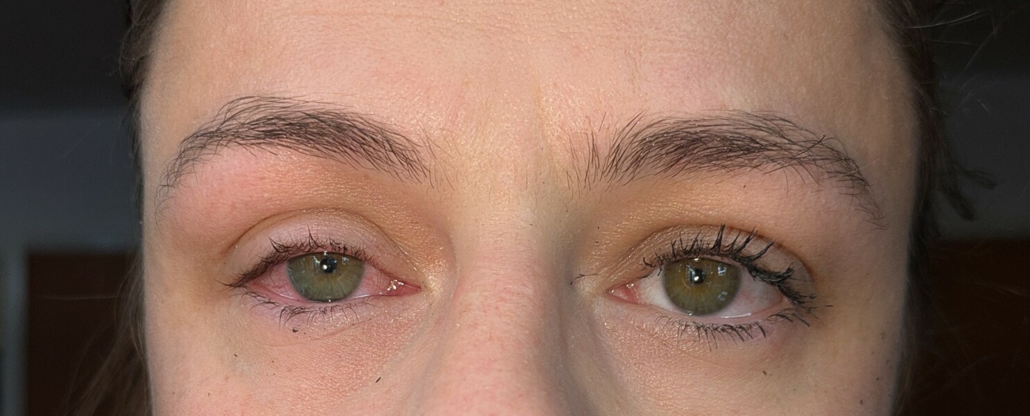 Antibacterial washing up in eye (photo)