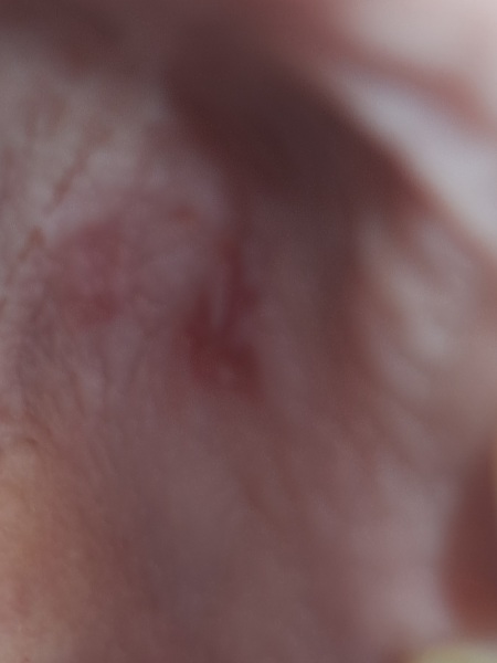 Is this Canker sores? Pic attached