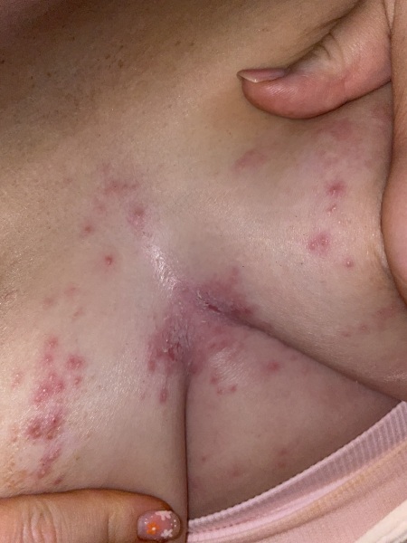 Spotty looking rash between breasts
