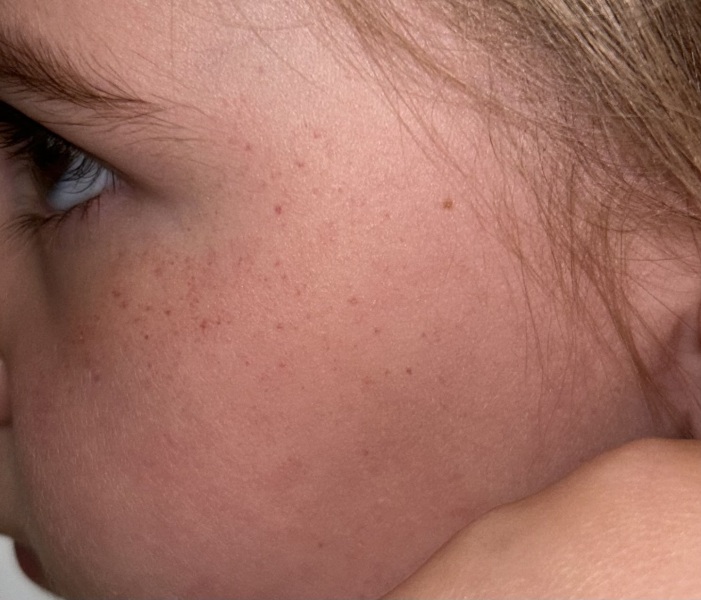 Rash on daughters cheeks