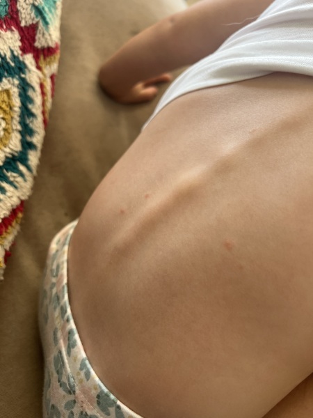 Advice Needed - Chickenpox or not?