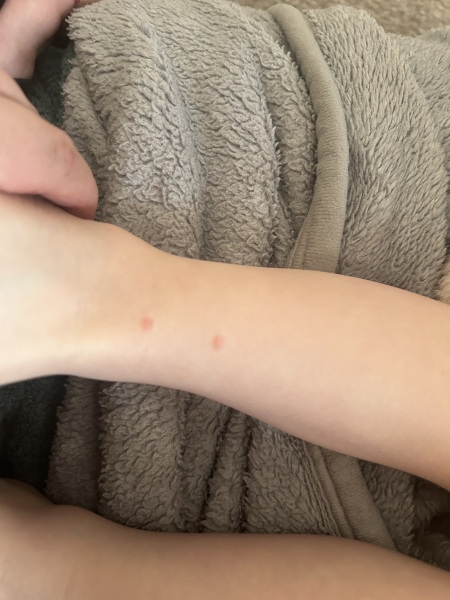 Does this look like chicken pox