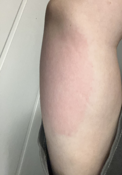 Worried about mosquito bite