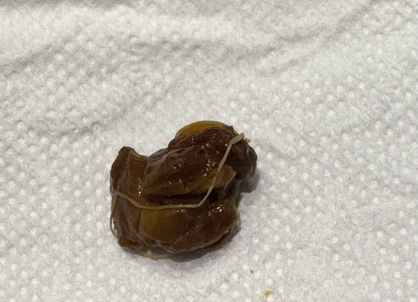 Worms? Worried mama  - pic attached, sorry 😔
